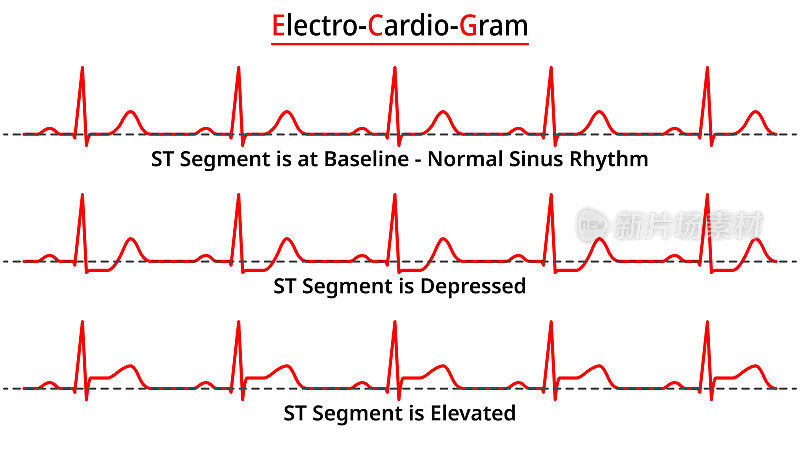 心电图常见异常- ST段升高vs ST段下降-正常窦性心律-医学矢量和说明